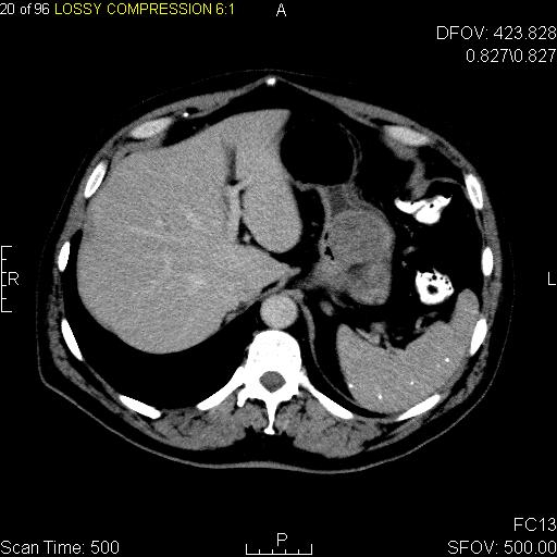 TC axial de abdome com contraste mostrando tumor estromal gastrointestinal como massa de partes moles bem delimitada que se realça, originada da parede do estômago.