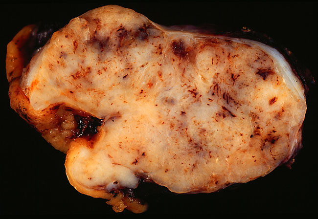 Peça cirúrgica em corte de tumor estromal gastrointestinal gástrico de 6,5 cm, mostrando superfície carnosa esbranquiçada com focos de hemorragia.