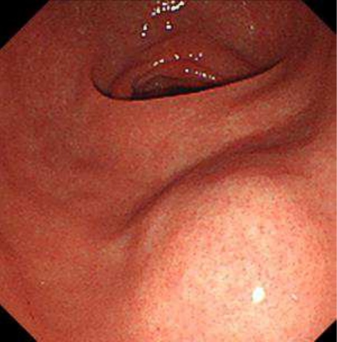 Endoscopia digestiva alta mostrando abaulamento submucoso arredondado de superfície lisa no corpo gástrico inferior, com mucosa íntegra recobrindo a lesão — aspecto macroscópico do GIST.