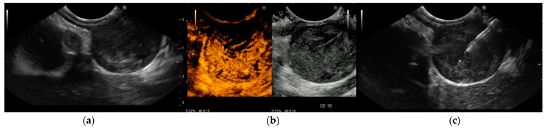 Ultrassonografia endoscópica de GIST gástrico mostrando a lesão submucosa hipoecoica e a camada de origem na parede, com punção aspirativa guiada por EUS.