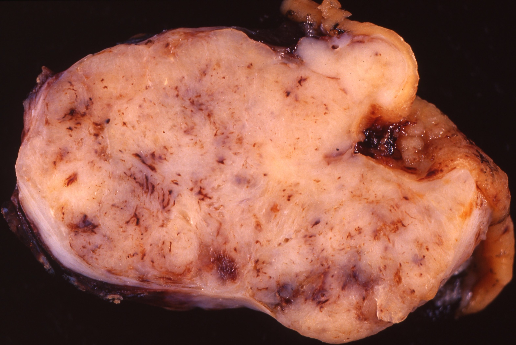Peça cirúrgica de tumor estromal gastrointestinal gástrico de 6,5 cm excisado em bloco com um anel de parede gástrica não acometida ao redor, demonstrando margem livre.