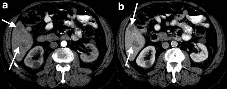 Tomografia computadorizada de abdome mostrando nódulo hipoatenuante no segmento 5 hepático, indicado por setas — metástase hepática de tumor estromal gastrointestinal (GIST).