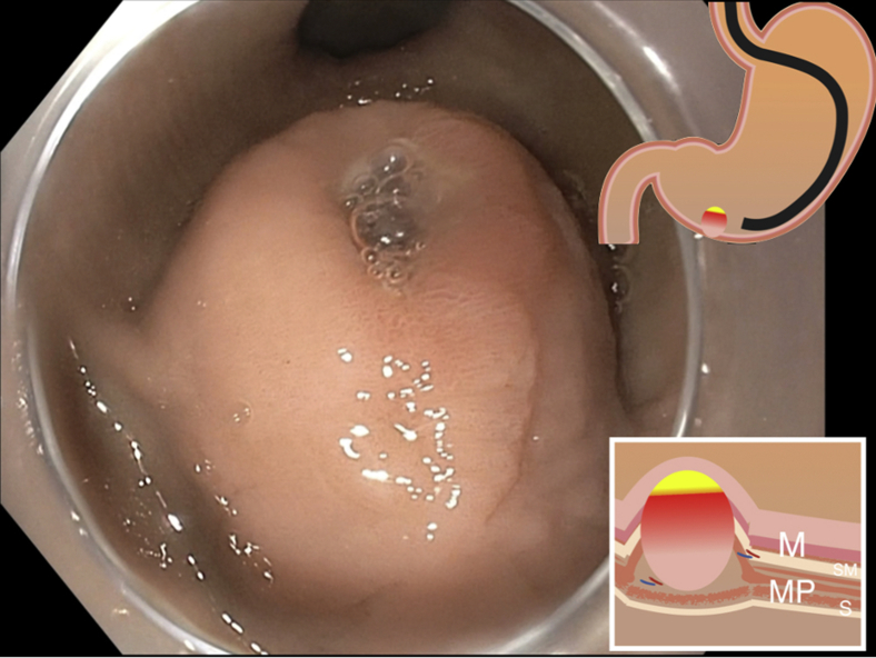 Endoscopia digestiva alta mostrando massa submucosa gástrica com ulceração central no ápice, sinal de alto risco em GIST.
