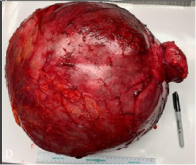 Peça cirúrgica macroscópica de neoplasia mucinosa de apêndice ressecada, sobre campo de patologia — o material que chega à bancada depois da apendicectomia.