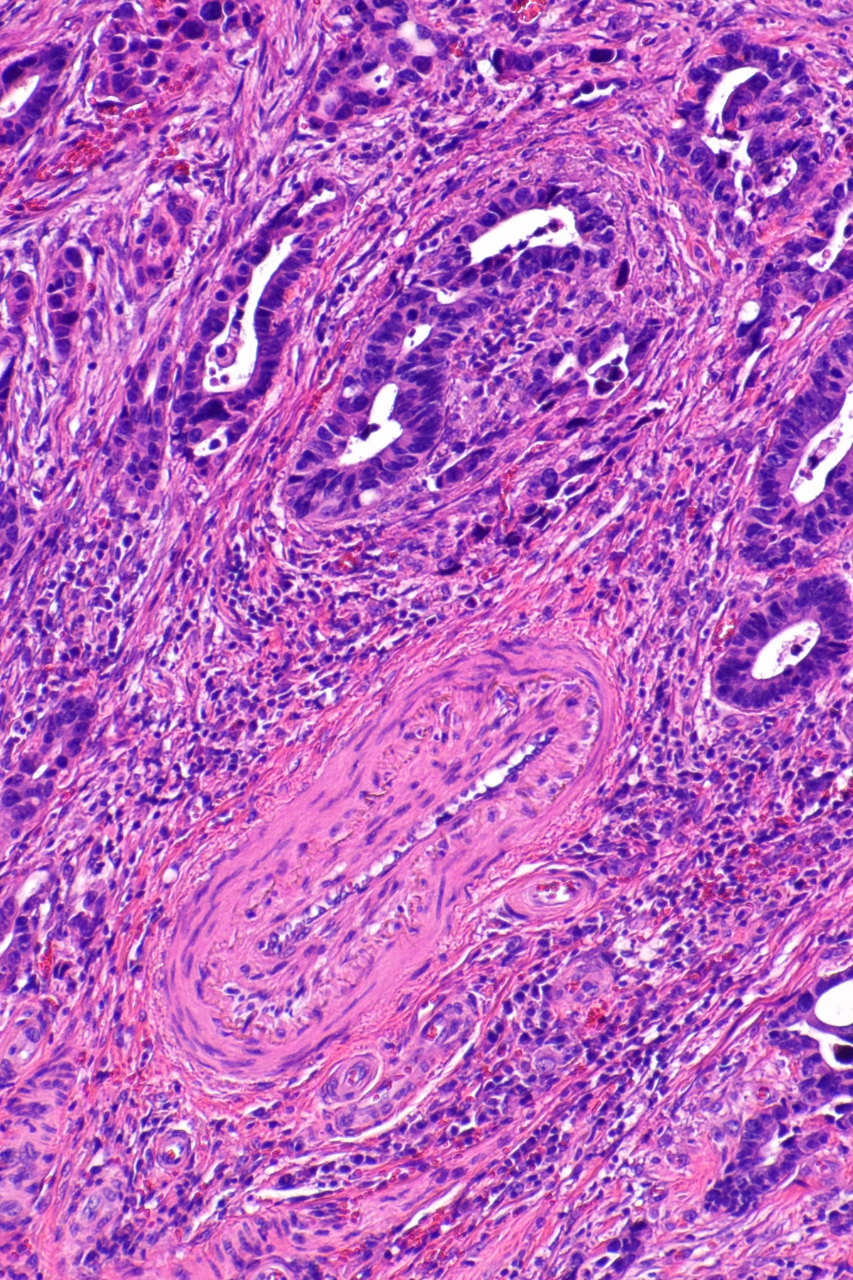 Lâmina histológica (H&E) demonstrando invasão linfovascular: êmbolo de células tumorais dentro de um espaço vascular revestido por endotélio.