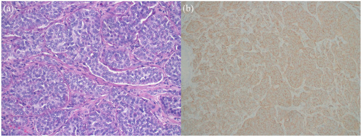 Lâmina histológica (H&E) de tumor neuroendócrino: ninhos sólidos em arranjo organoide com cromatina em sal e pimenta — a célula que produz as substâncias da síndrome carcinoide.
