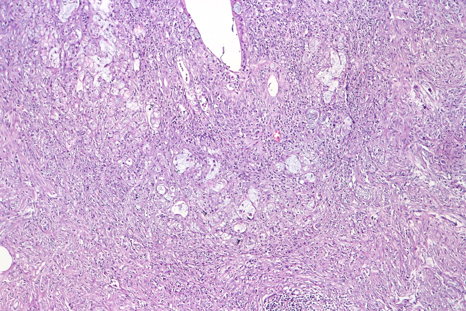 Lâmina histológica (H&E) de adenocarcinoma de apêndice: células tumorais e ninhos glandulares atípicos infiltrando a parede — a mesma assinatura glandular maligna do câncer de cólon.