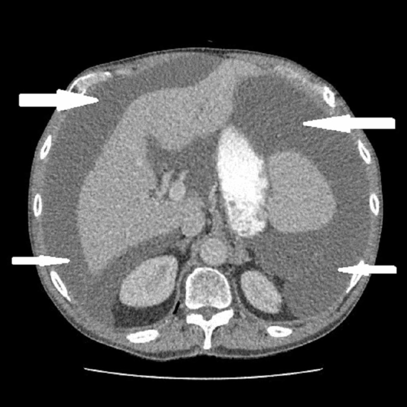 Tomografia de abdome mostrando ascite mucinosa de alta densidade preenchendo a cavidade peritoneal — o pseudomixoma peritoneal, o 'jelly belly'.
