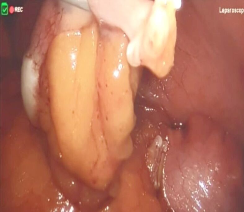 Apêndice exposto no intraoperatório com parede acentuadamente espessada e ponta distal distendida e nodular, de aspecto pálido — o espessamento suspeito que obriga a decidir a conduta na mesa.