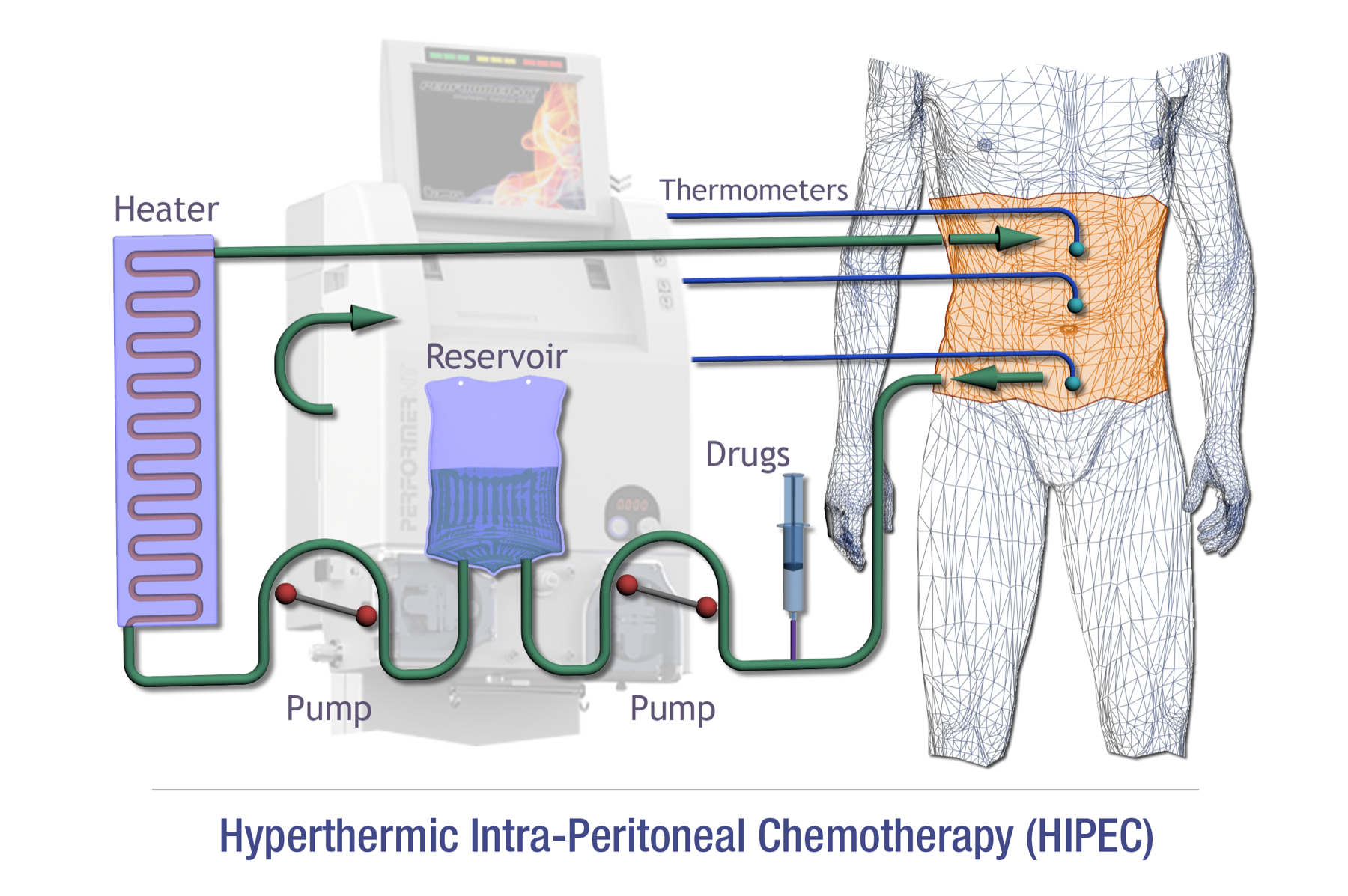 Esquema do circuito de HIPEC: solução com quimioterápico aquecida circulando pela cavidade peritoneal por cânulas de entrada e saída.