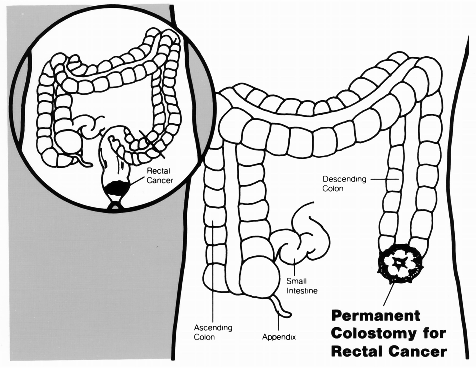Ilustração médica de colostomia permanente — estoma proximal criado pelo abdome.