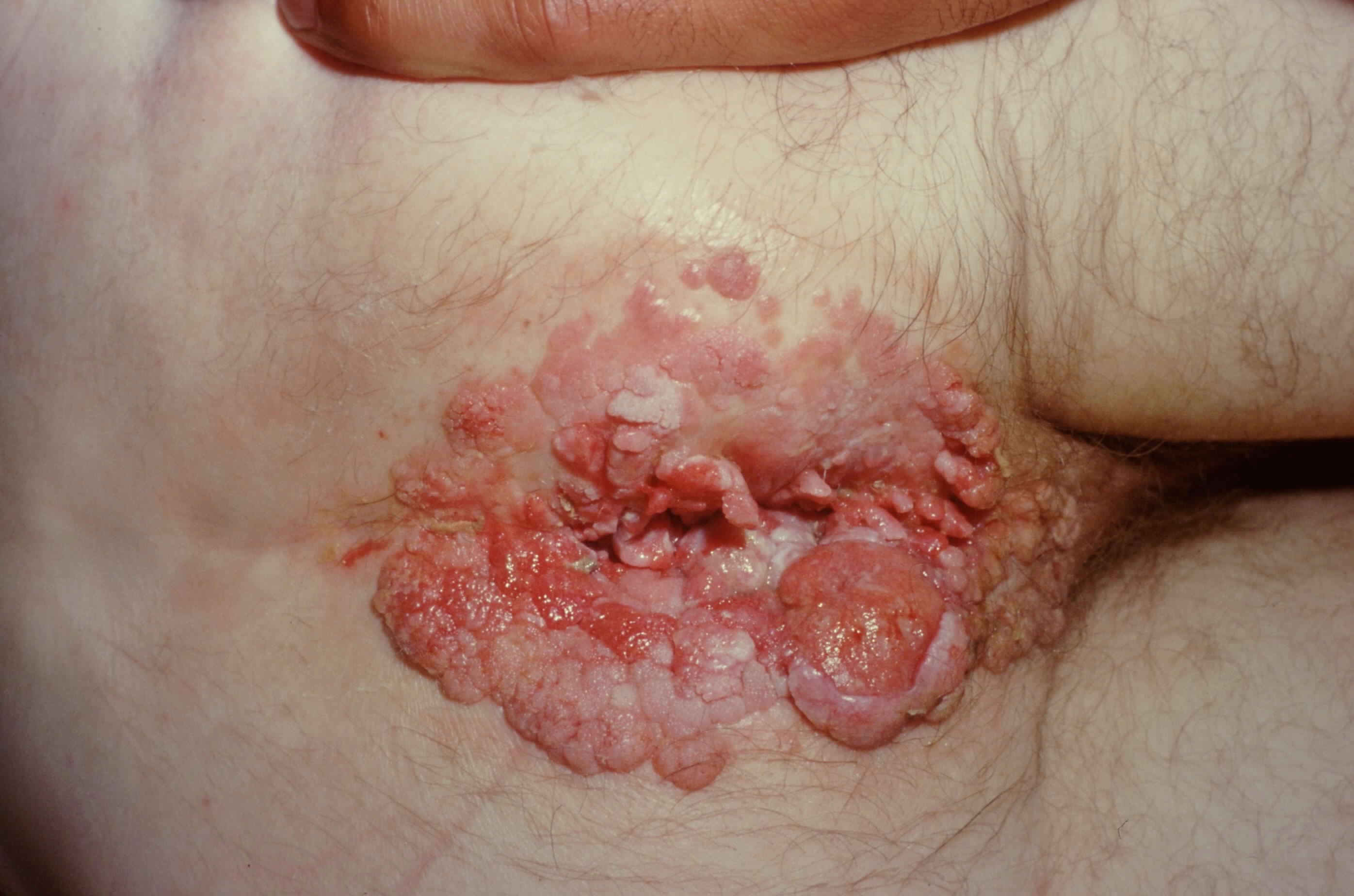 Foto clínica sóbria de carcinoma anal avançado — lesão anal ulcerada, a apresentação que sugere neoplasia.