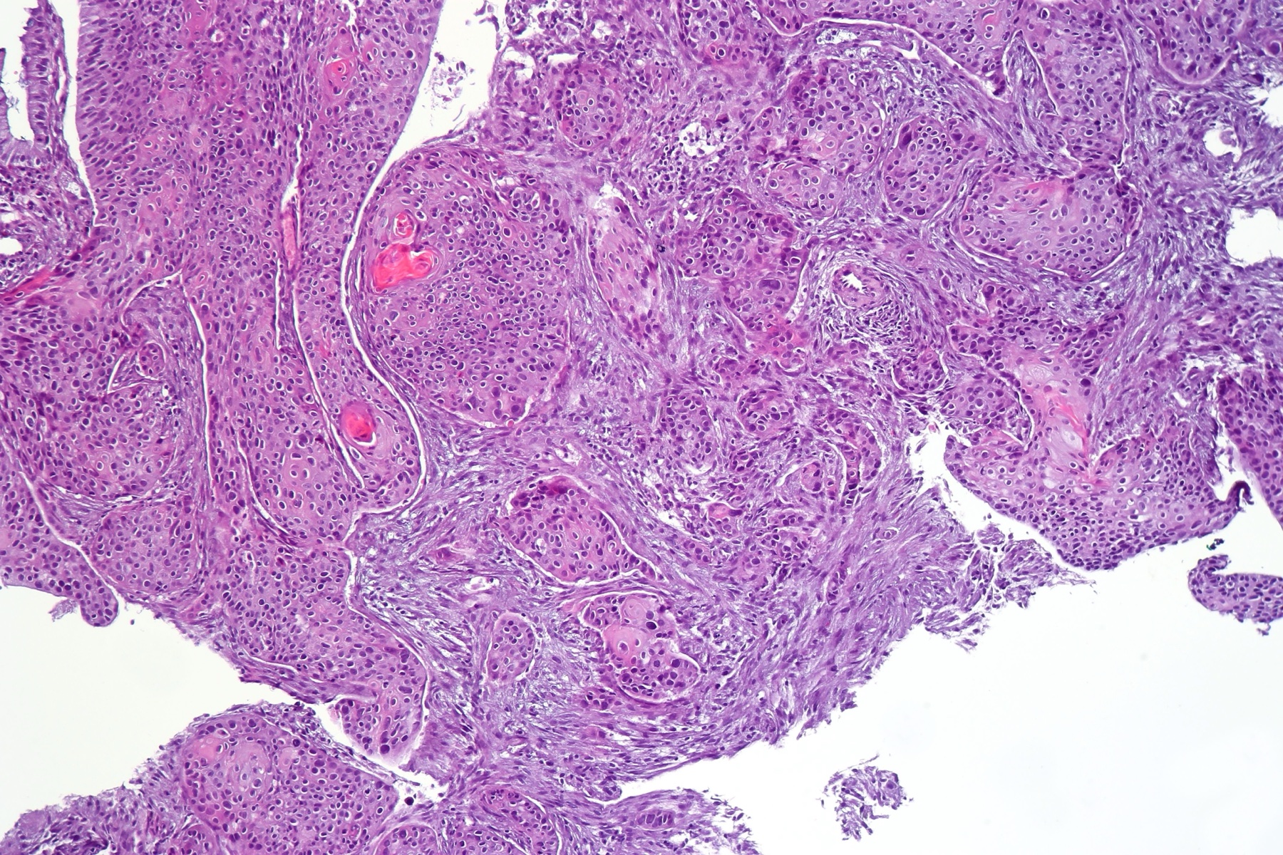 Lâmina histológica (H&E) de carcinoma escamoso do canal anal mostrando ninhos de células escamosas com queratinização focal.