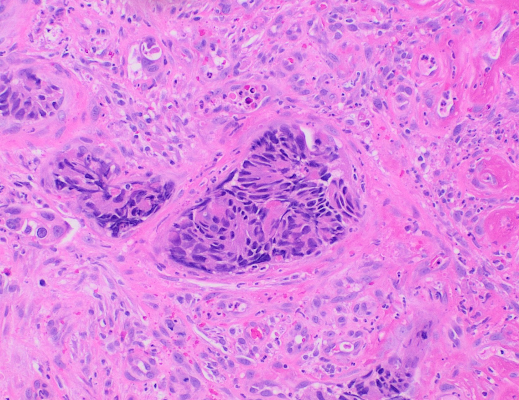 Lâmina histológica (H&E) de adenocarcinoma colorretal mostrando arquitetura glandular neoplásica, em contraste com os ninhos escamosos do canal anal.