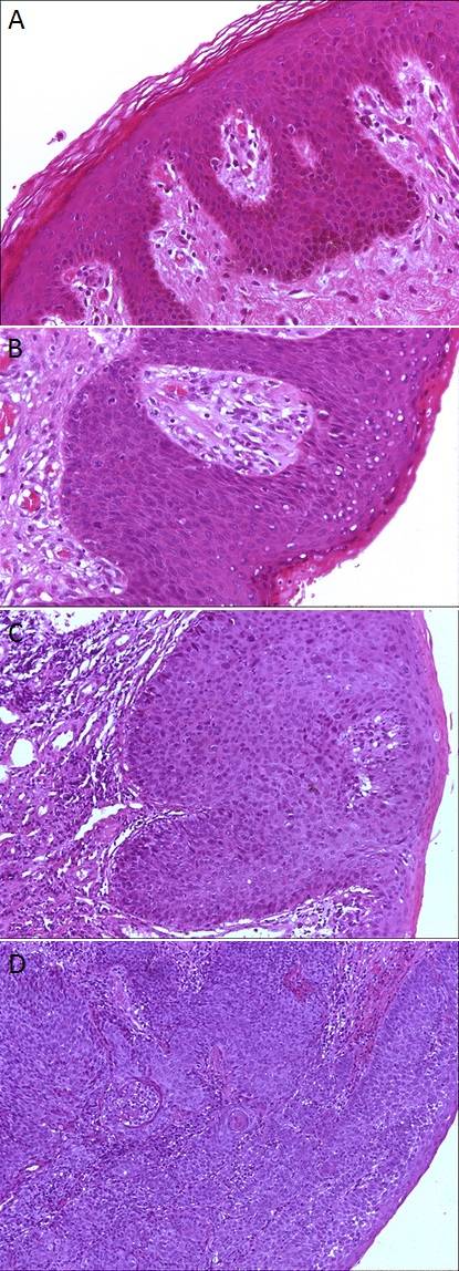 Painel histológico do epitélio escamoso anal: histologia normal, displasia de baixo grau, displasia de alto grau e carcinoma escamoso.