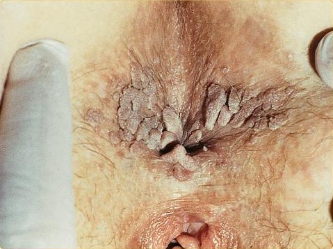 Foto clínica sóbria de condiloma acuminado perianal por HPV — verrugas anogenitais na região perianal.