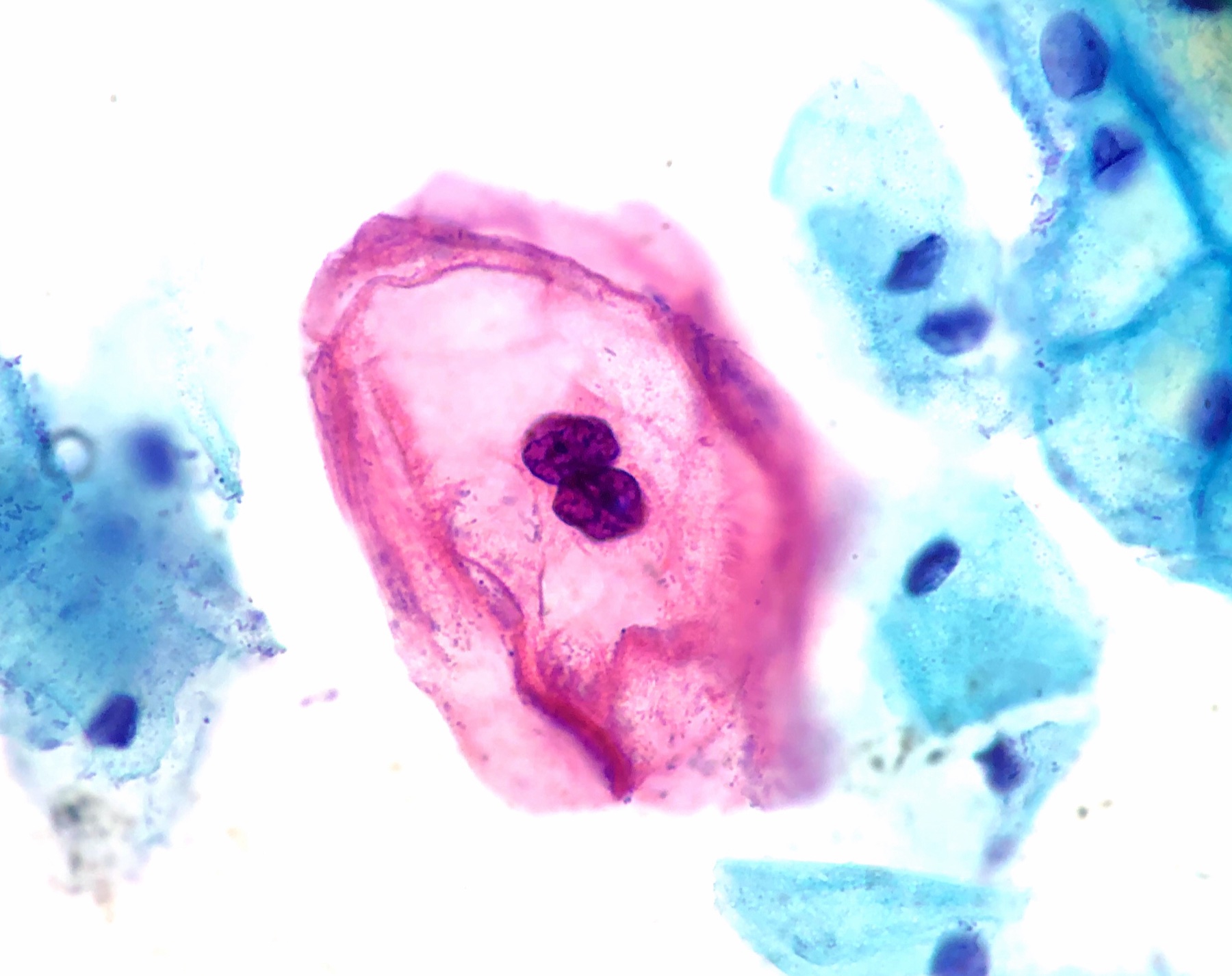 Citologia mostrando coilócito — célula escamosa com halo perinuclear e núcleo atípico, a marca citopática do HPV.