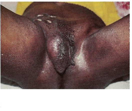 Foto clínica sóbria de adenopatia inguinal — linfonodo aumentado palpável na virilha.