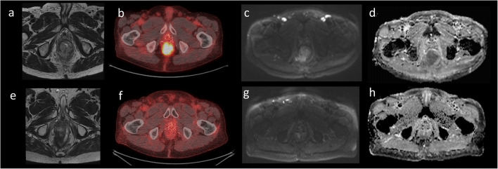 Figura composta de FDG PET-CT e ressonância de pelve, antes e depois da quimiorradioterapia, em carcinoma escamoso do canal anal: antes, massa hipermetabólica no canal anal e reto baixo com linfonodos inguinais captantes; depois, ausência de doença FDG-ávida residual — resposta metabólica completa.