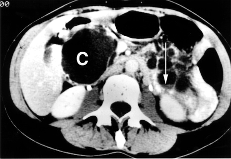 Corte axial de TC abdominal mostrando volumosa lesão cística pancreática como achado, com nível líquido-debris na cauda do pâncreas.