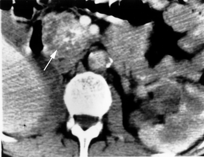 TC de cistoadenoma seroso da cabeça do pâncreas, com inúmeros microcistos somados em massa e calcificação central, padrão favo-de-mel.