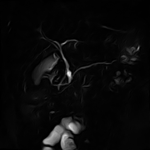 Colangiopancreatografia por RM (MIP) de IPMN de ducto secundário comunicando-se com o sistema ductal pancreático.