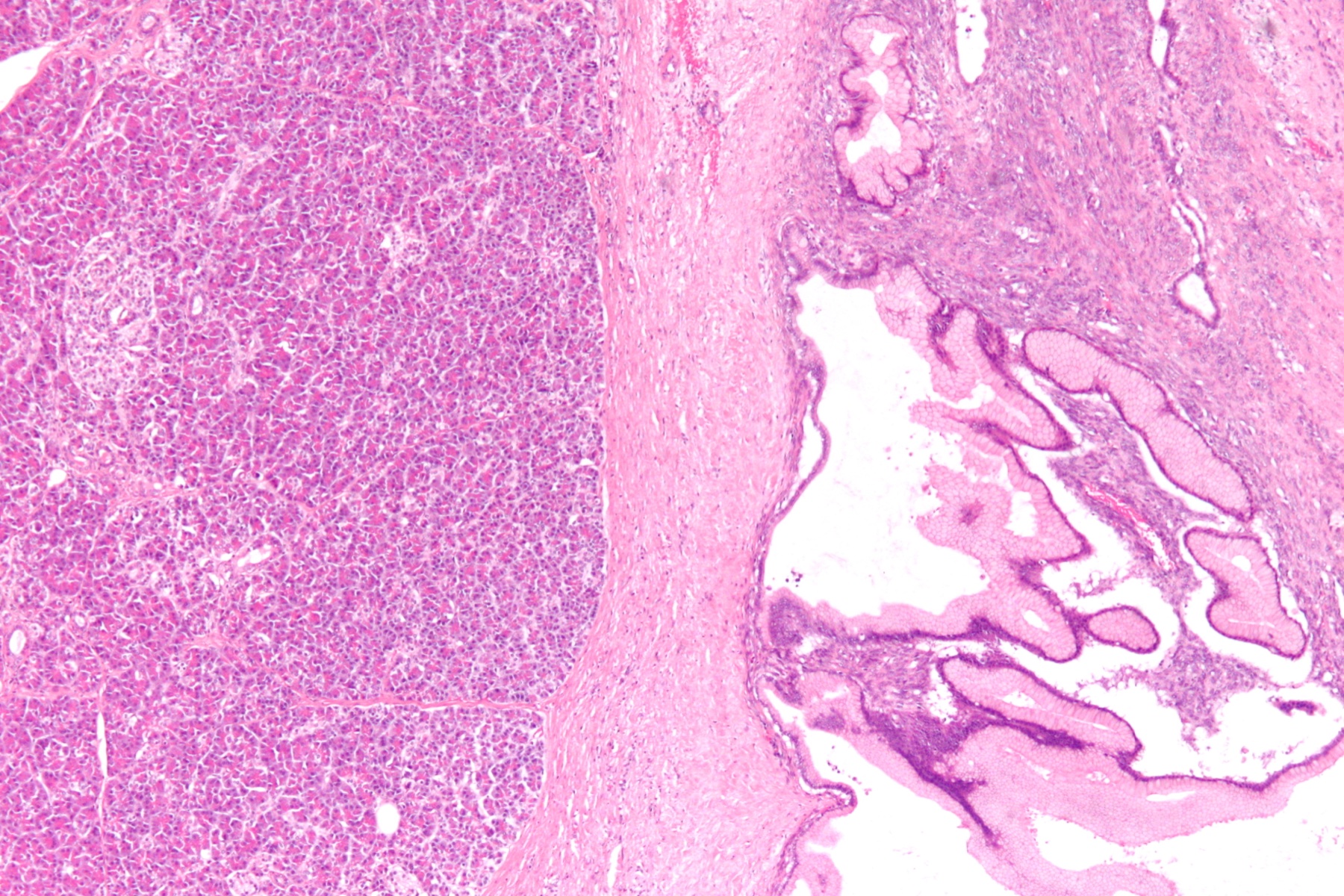 Lâmina histológica (H&E) de neoplasia cística mucinosa do pâncreas, com epitélio mucinoso revestindo a parede do cisto e estroma tipo ovariano.
