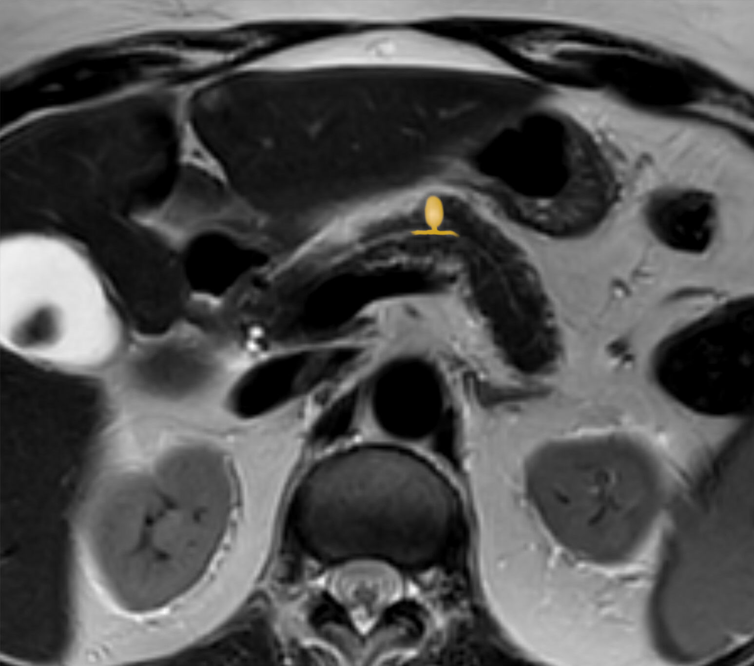 RM T2 axial anotada de IPMN de ducto secundário do pâncreas, com a lesão cística mucinosa em relação ao sistema ductal.