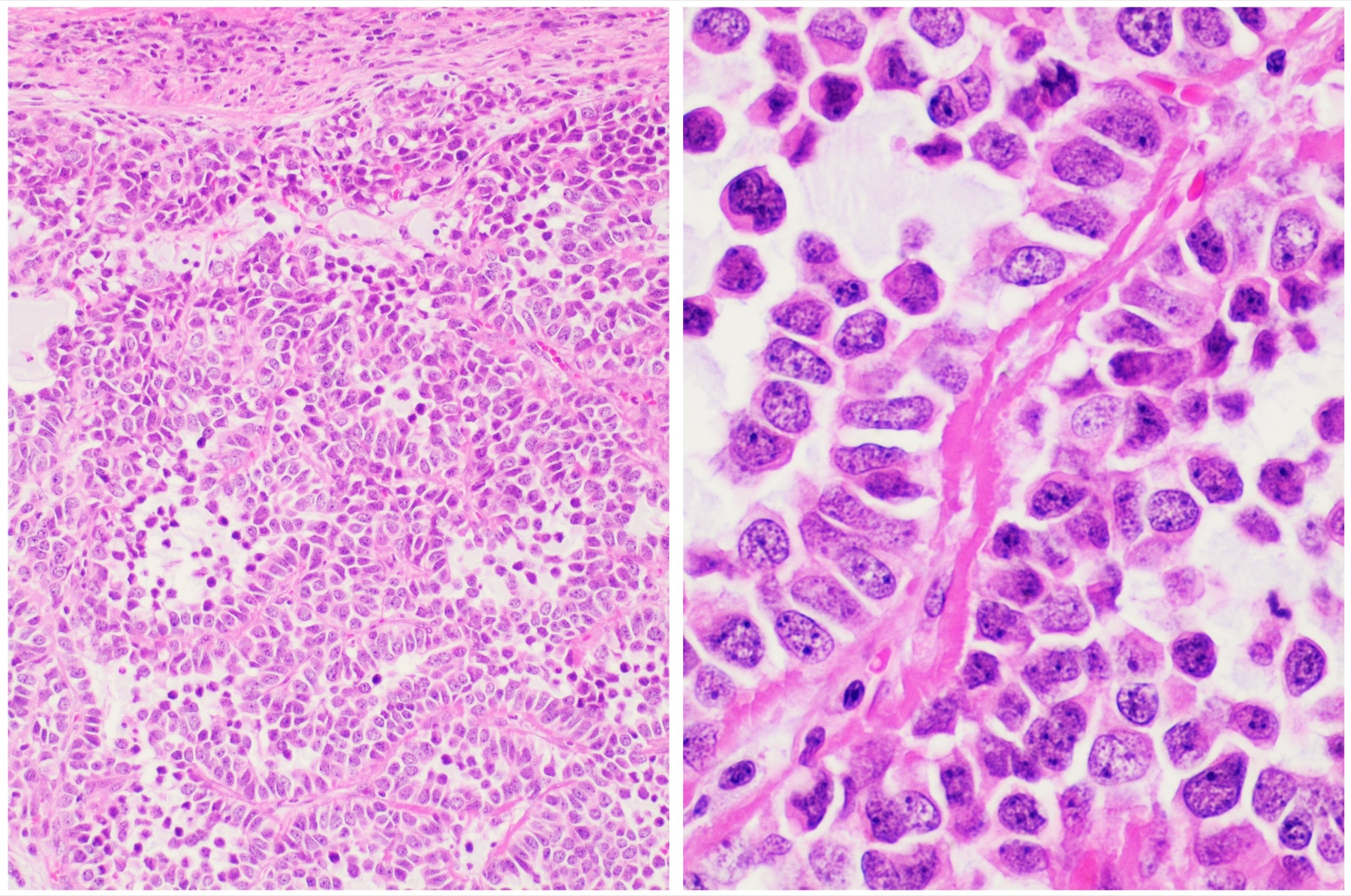 Lâmina histológica de tumor sólido-pseudopapilar (Frantz) com lençóis sólidos de células focalmente discoesas e glóbulos hialinos.