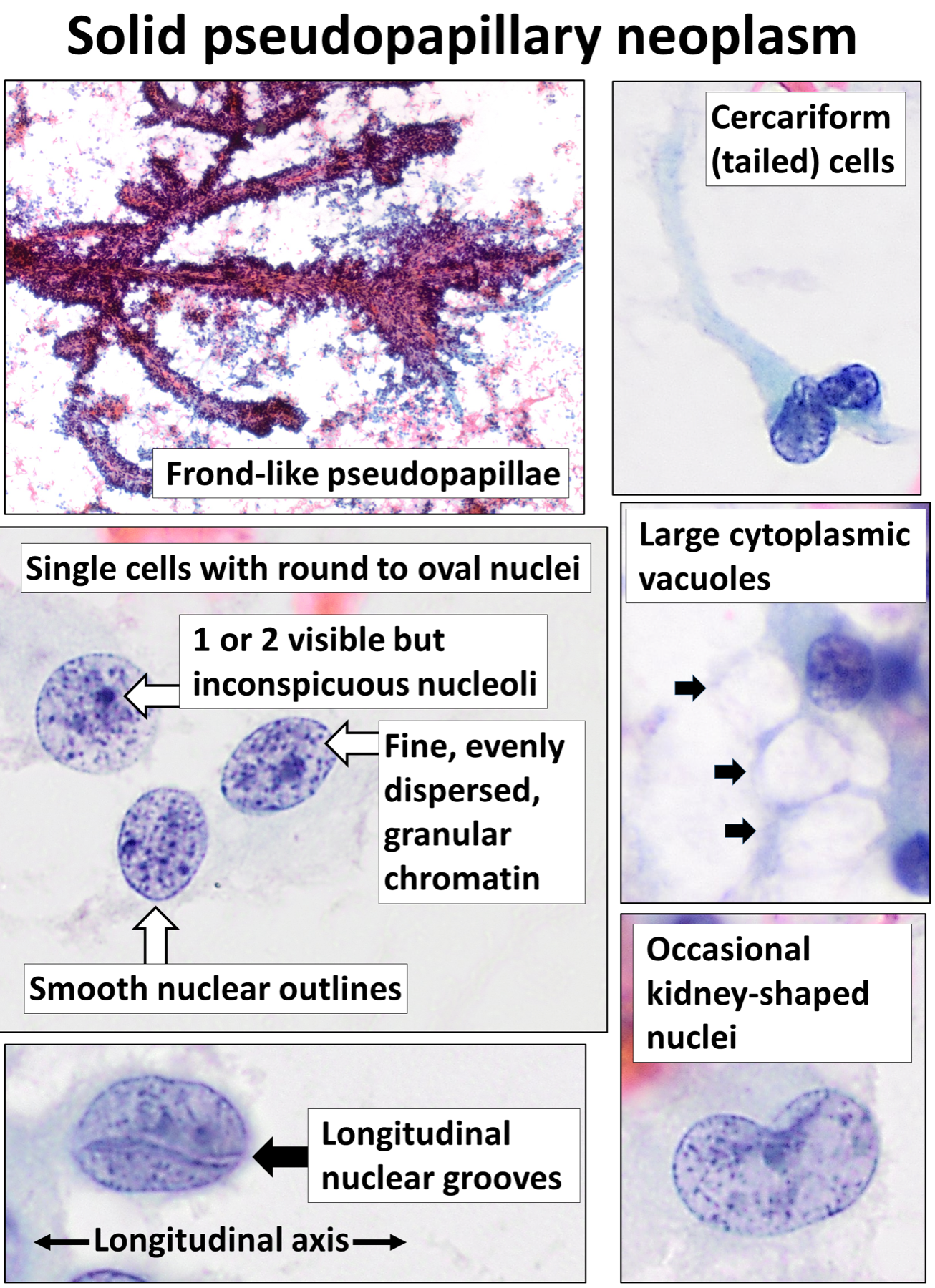 Lâmina de citologia obtida por ecoendoscopia com PAAF (EUS-FNA) de lesão cística pancreática.