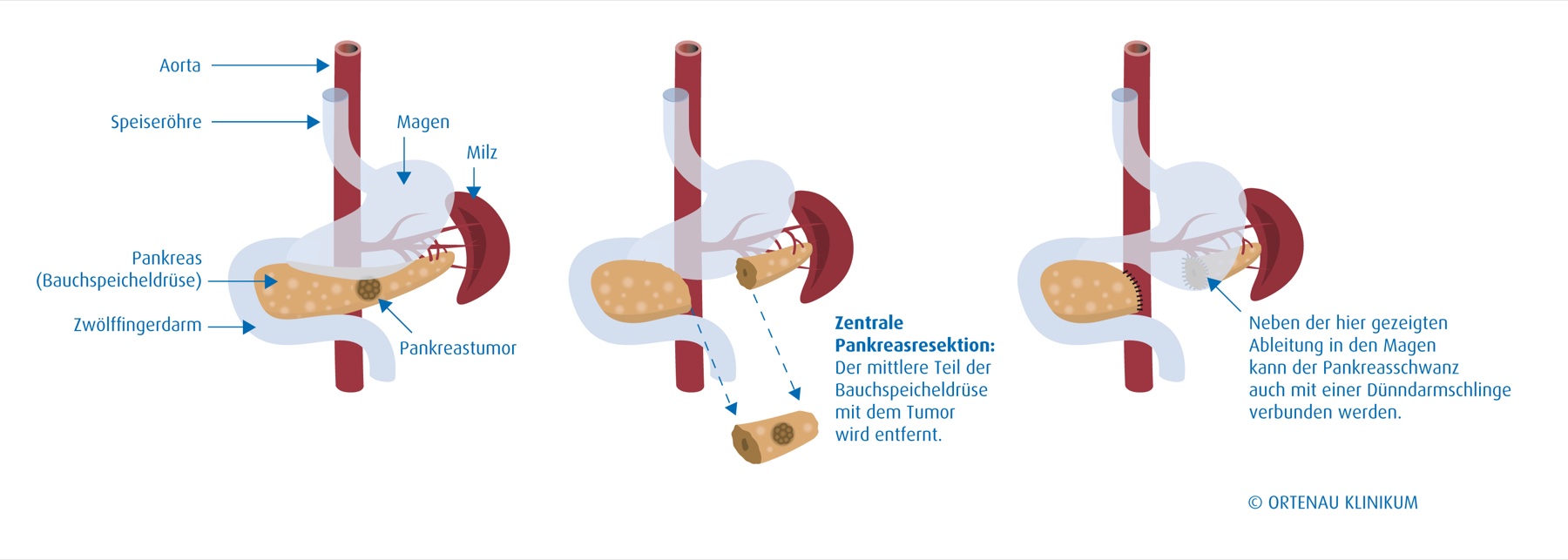 Esquema anatômico de pancreatectomia parcial distal, com ressecção de corpo e cauda do pâncreas.