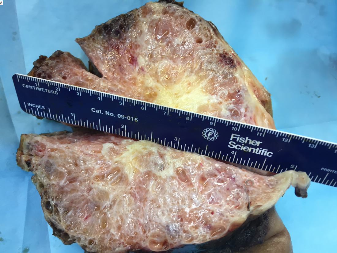 Peça cirúrgica de cistoadenoma seroso microcístico volumoso do pâncreas, superfície de corte esponjosa em favo de mel, com régua evidenciando lesão de grande tamanho.