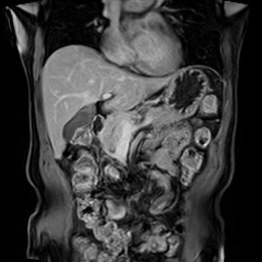 RM coronal T2 do abdome mostrando IPMN como lesão cística multilobulada e septada junto ao sistema ductal pancreático.