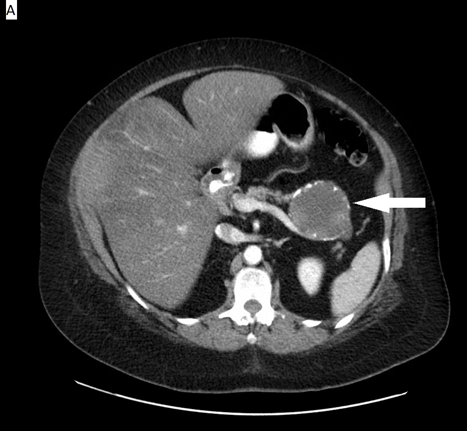 TC axial com contraste mostrando neoplasia cística mucinosa do pâncreas: lesão macrocística de poucos lóculos grandes e septos grosseiros, indicada por seta.
