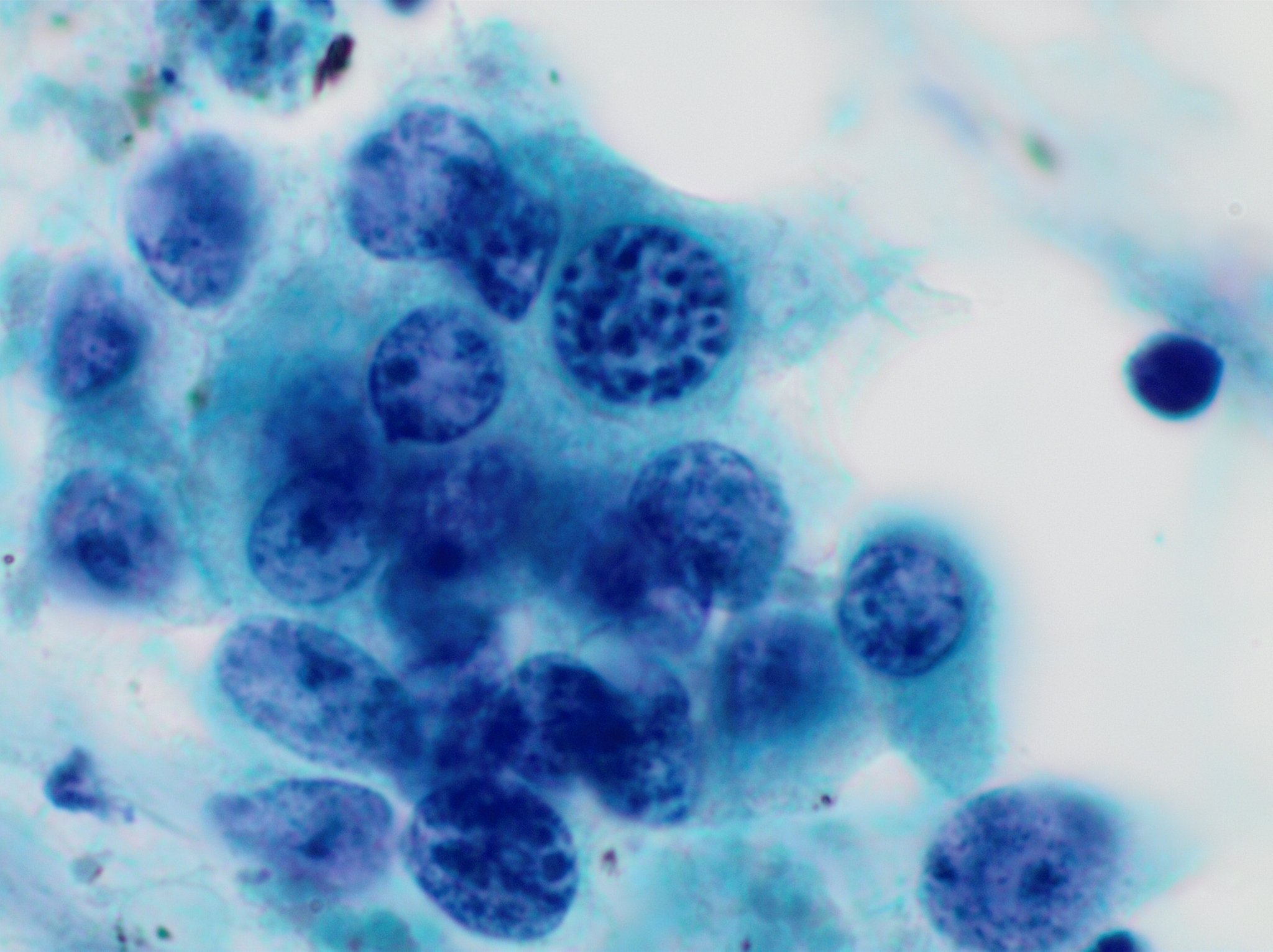 Citologia de PAAF pancreática por ecoendoscopia, coloração de Papanicolaou, com grupo de células epiteliais de cromatina fina.