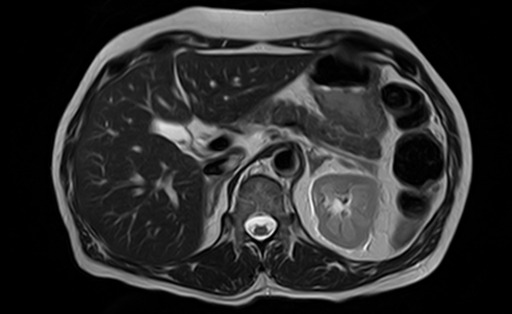 RM axial T2 mostrando IPMN de ducto secundário como cisto pancreático bem delimitado em corpo/cauda, lesão típica de vigilância por tamanho.