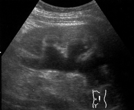 Ultrassonografia renal mostrando hidronefrose, com dilatação do sistema pielocalicial por obstrução do trato urinário.