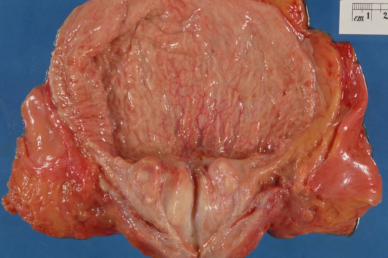 Peça macroscópica de próstata aumentada com nódulos de hiperplasia junto ao colo vesical; parede da bexiga espessada e trabeculada.