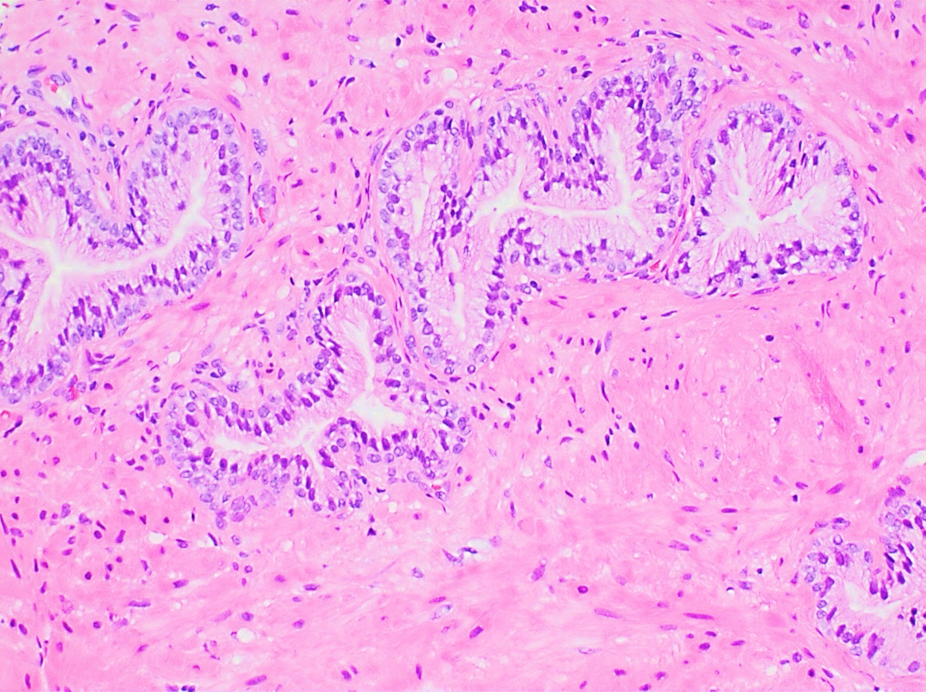 Microfotografia H&E de próstata com glândulas envoltas por estroma fibromuscular, o tecido-alvo do alfabloqueador e do 5-ARI.