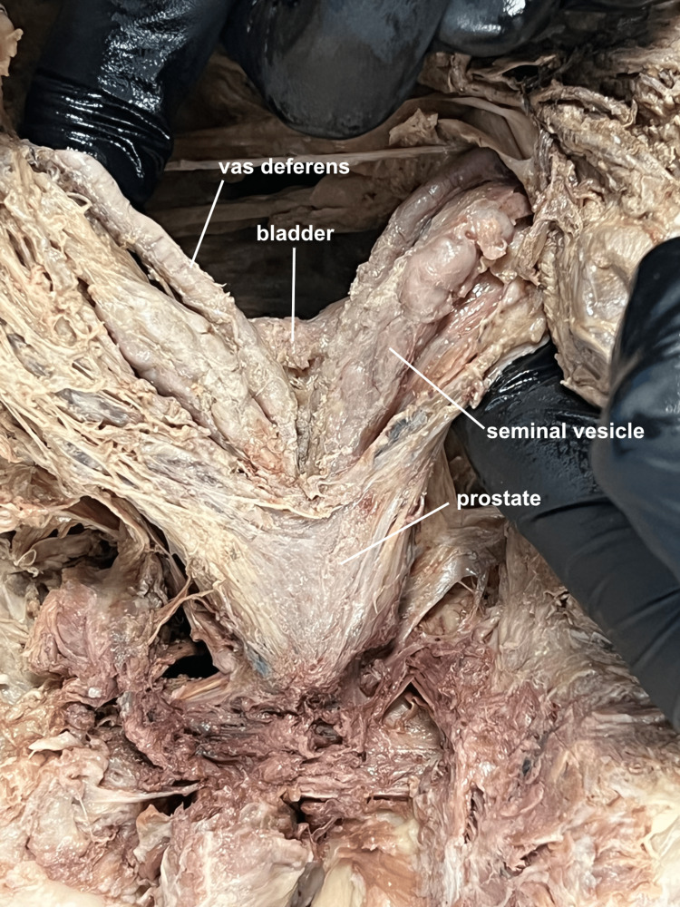 Fotografia de dissecção cadavérica em vista posterior do baixo trato urinário masculino, mostrando a bexiga, a próstata imediatamente abaixo dela, as vesículas seminais e o ducto deferente em relação anatômica.