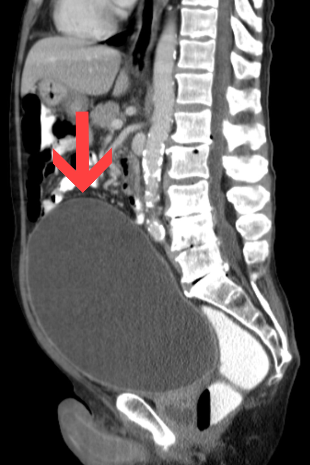 Tomografia computadorizada do abdome mostrando bexiga urinária maciçamente distendida ocupando grande parte do abdome inferior, caracterizando globo vesical na retenção urinária aguda.