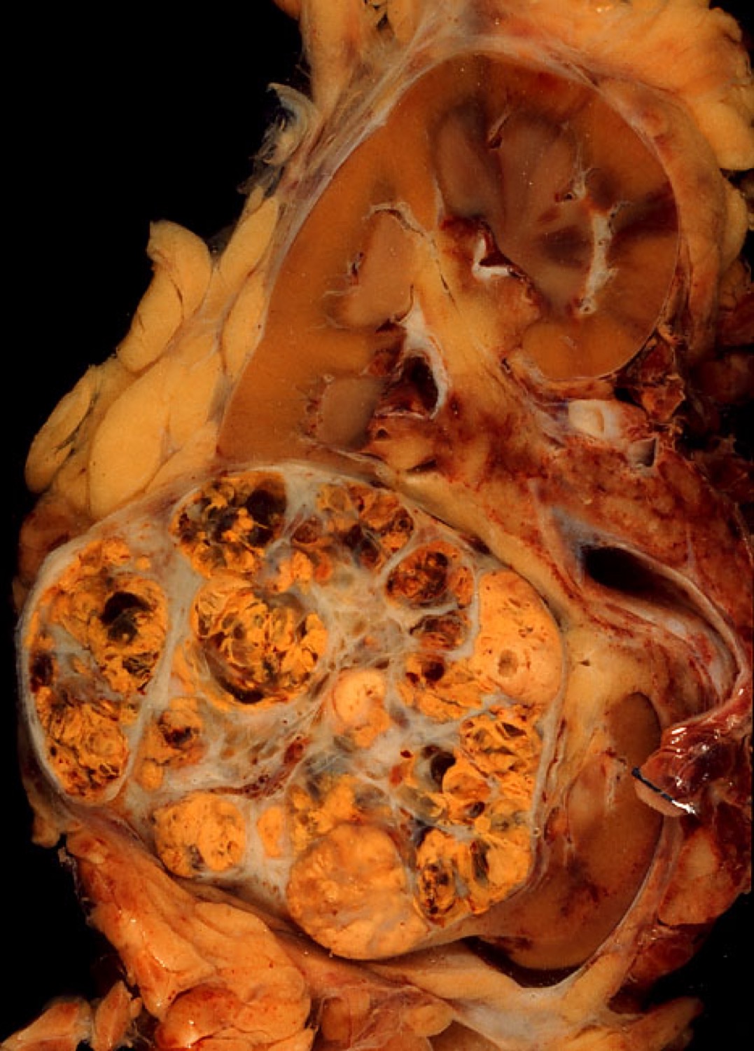 Peça de rim seccionada com carcinoma de células claras amarelado no polo inferior, bem delimitado, sem invadir a gordura ao redor.