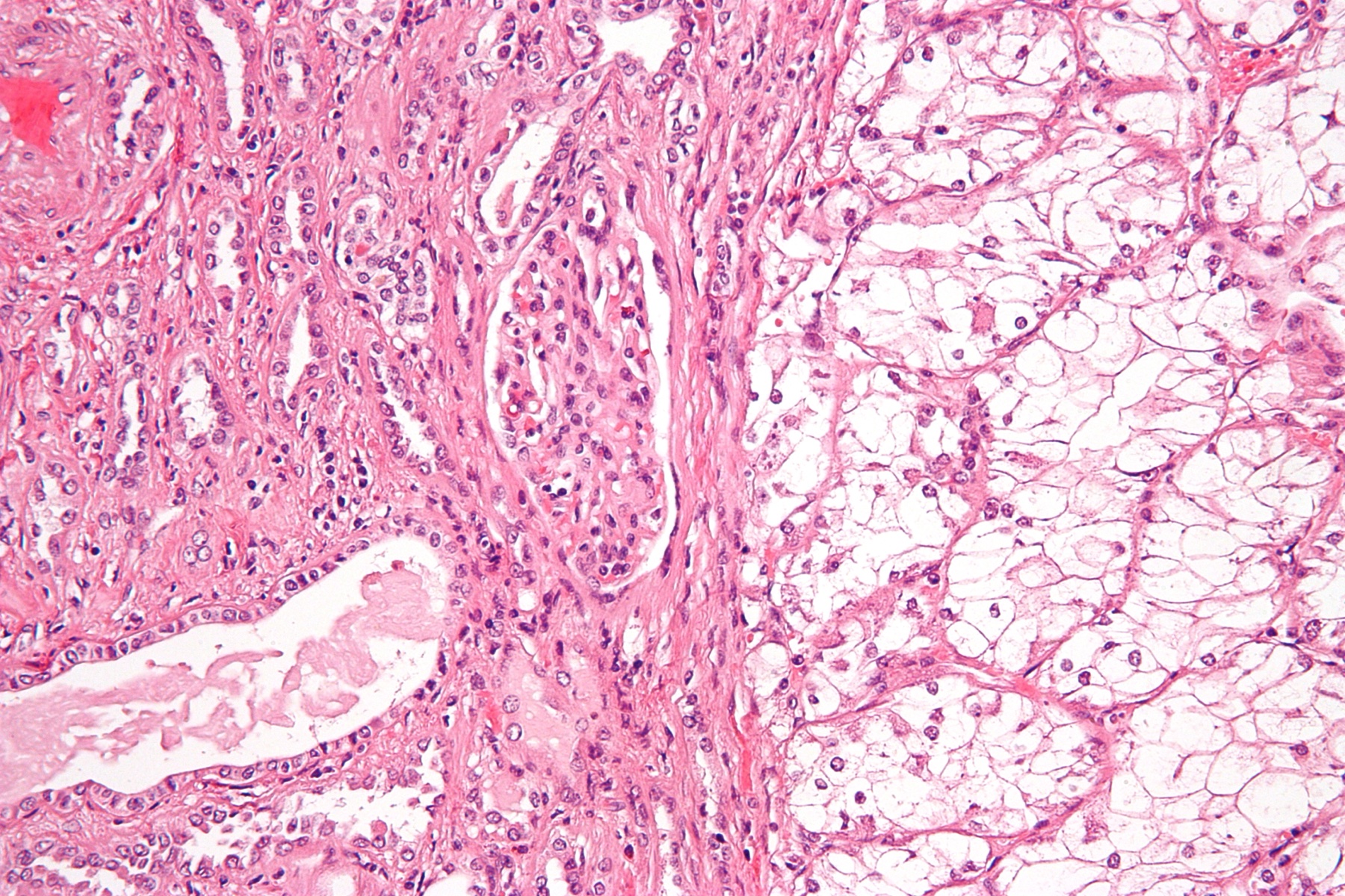 Microscopia H&E de carcinoma renal de células claras: ninhos de células tumorais com citoplasma claro e atipia nuclear.