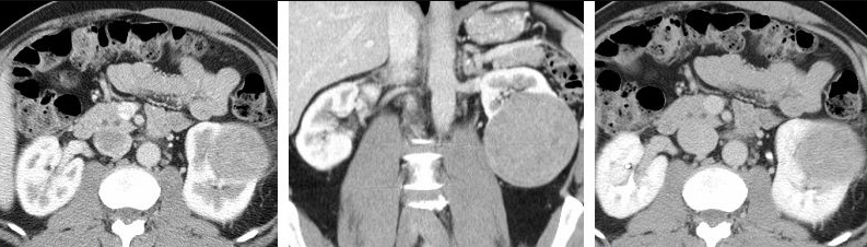 TC de abdome com contraste: massa renal sólida que realça nas fases corticomedular e parenquimatosa.