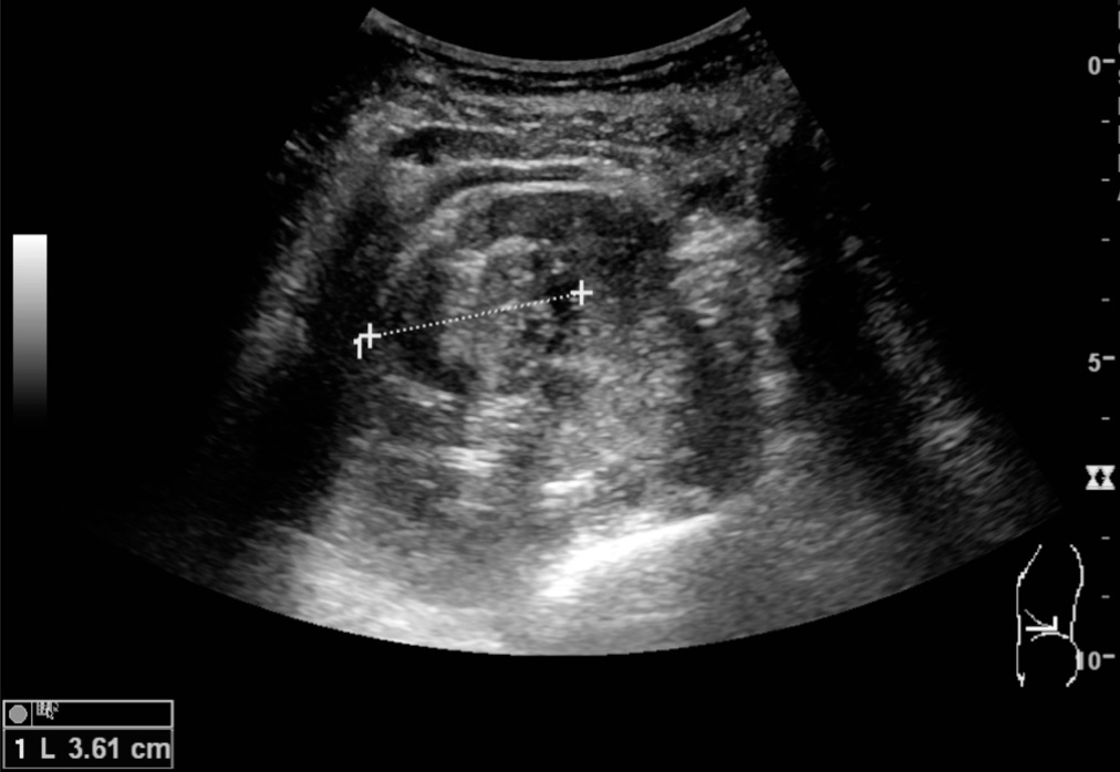 Ultrassonografia renal: massa sólida cortical confirmada como carcinoma de células renais, com marcadores de dimensão.