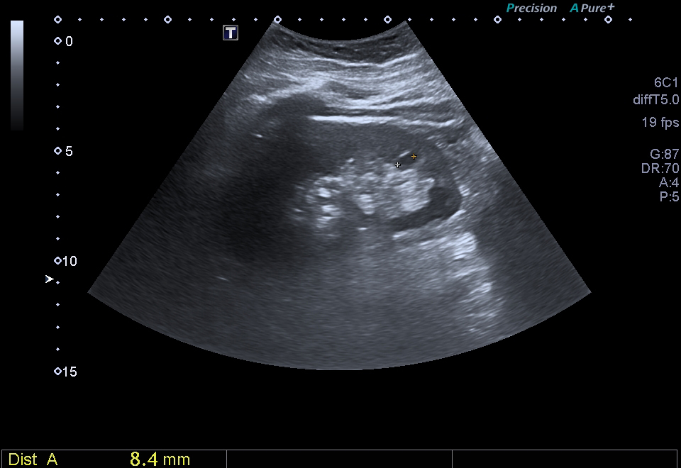 Ultrassonografia renal: cisto simples anecoico de parede fina, sem septos — padrão Bozniak 1.