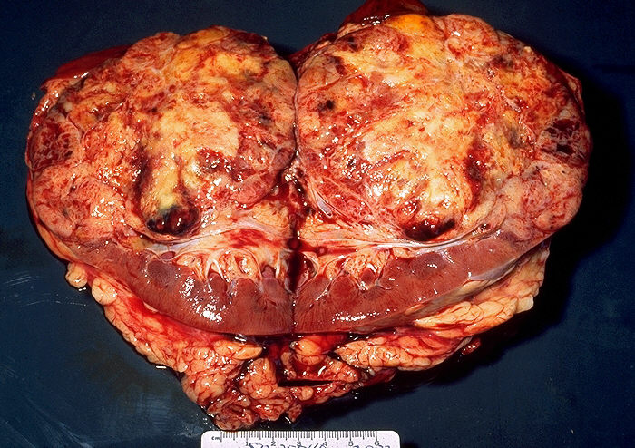 Peça de nefrectomia: rim cortado ao meio mostrando grande carcinoma de células renais substituindo o parênquima.