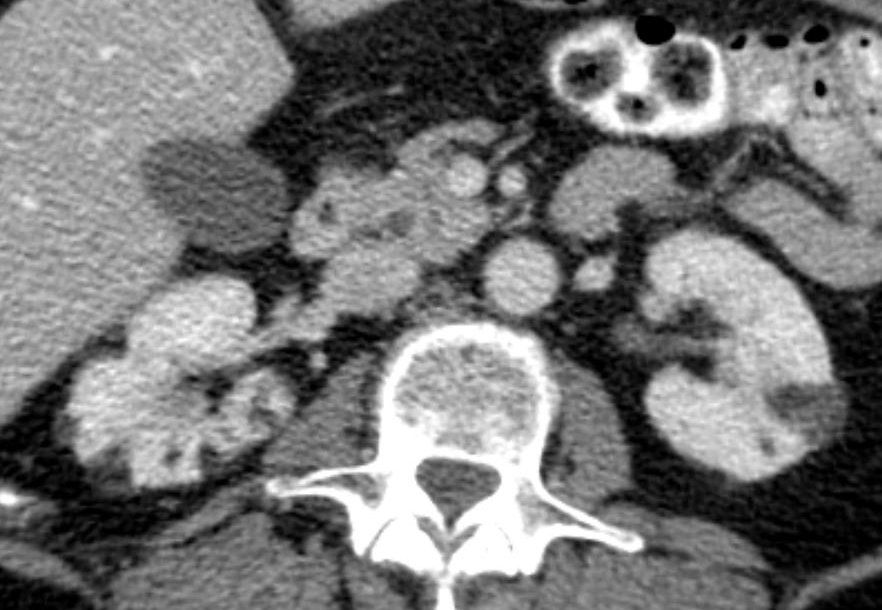 TC mostrando múltiplos angiomiolipomas renais com componente de gordura macroscópica, em paciente com suspeita de esclerose tuberosa.