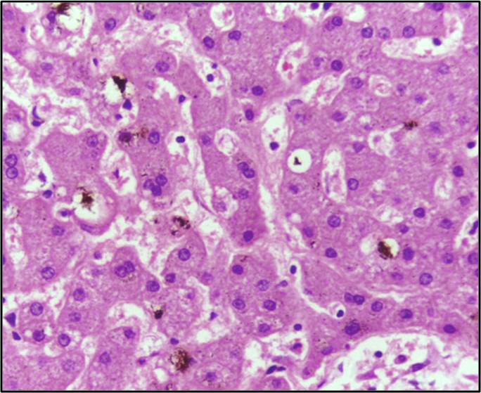 Histologia hepática H&E mostrando acúmulo canalicular de pigmento biliar (colestase intra-hepática), com fígado sem tumor — substrato da síndrome de Stauffer.