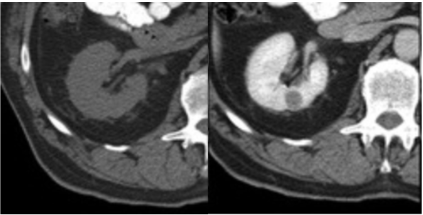 TC renal em duas fases (sem contraste e fase nefrográfica) mostrando carcinoma renal papilífero sólido de 1 cm no córtex renal direito, com realce após contraste.